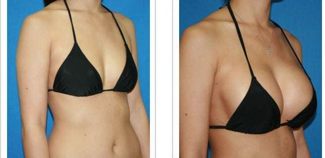breastfast resultat