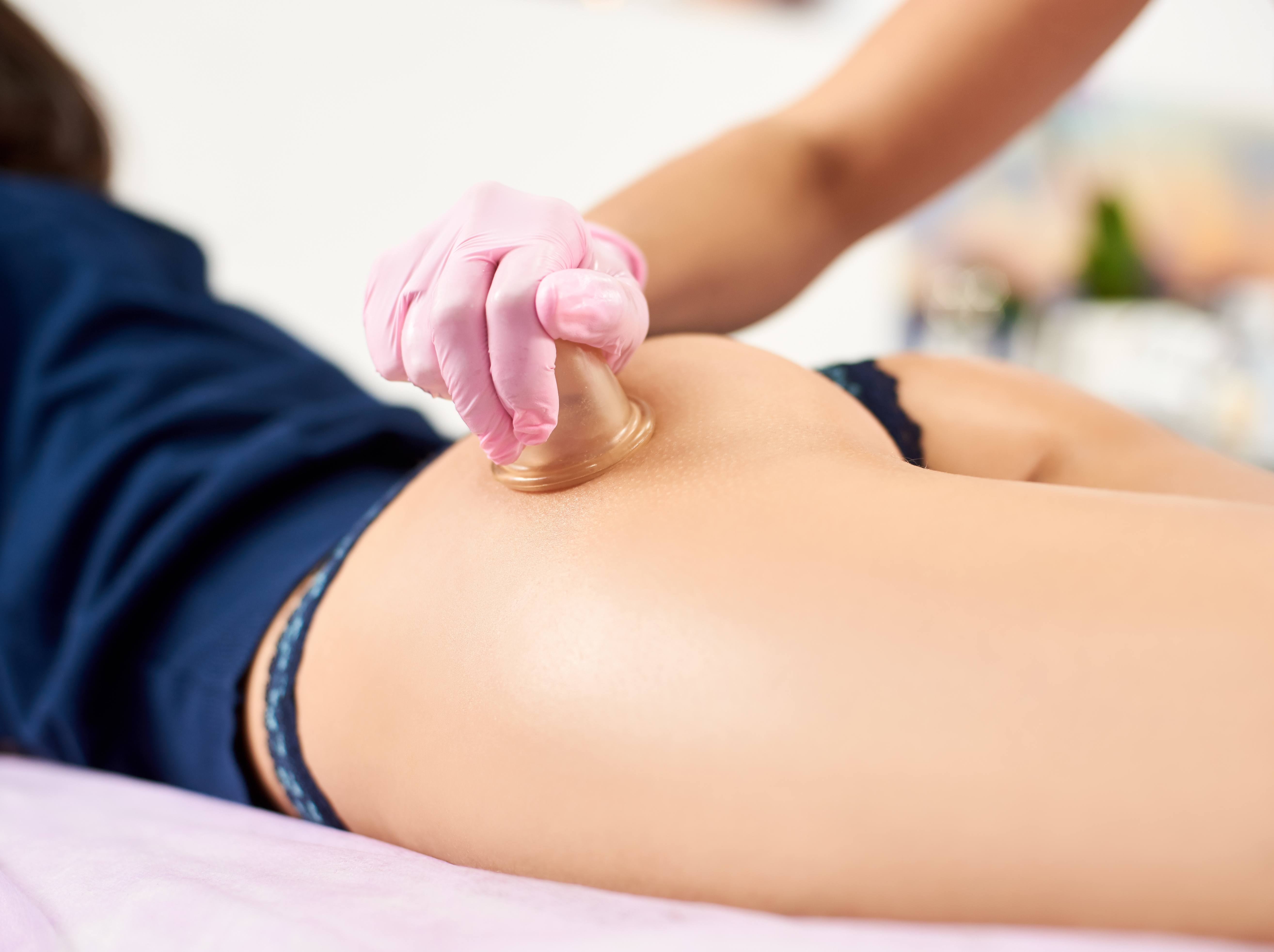 Schröpfen gegen Cellulite